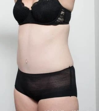 Before and after Abdominoplasty by Dr Eddie Cheng, Brisbane