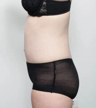 Before and after Abdominoplasty by Dr Eddie Cheng, Brisbane