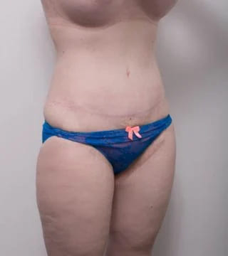 Before and after Abdominoplasty by Dr Eddie Cheng, Brisbane