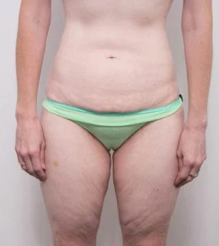 Before and after Surgery by Dr Eddie Cheng, Brisbane