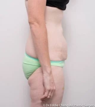 Before and after Surgery by Dr Eddie Cheng, Brisbane