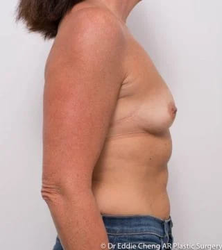 Before and after breast augmentation surgery by Dr Eddie Cheng, Brisbane
