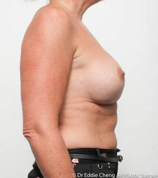 Before and after breast augmentation surgery by Dr Eddie Cheng, Brisbane
