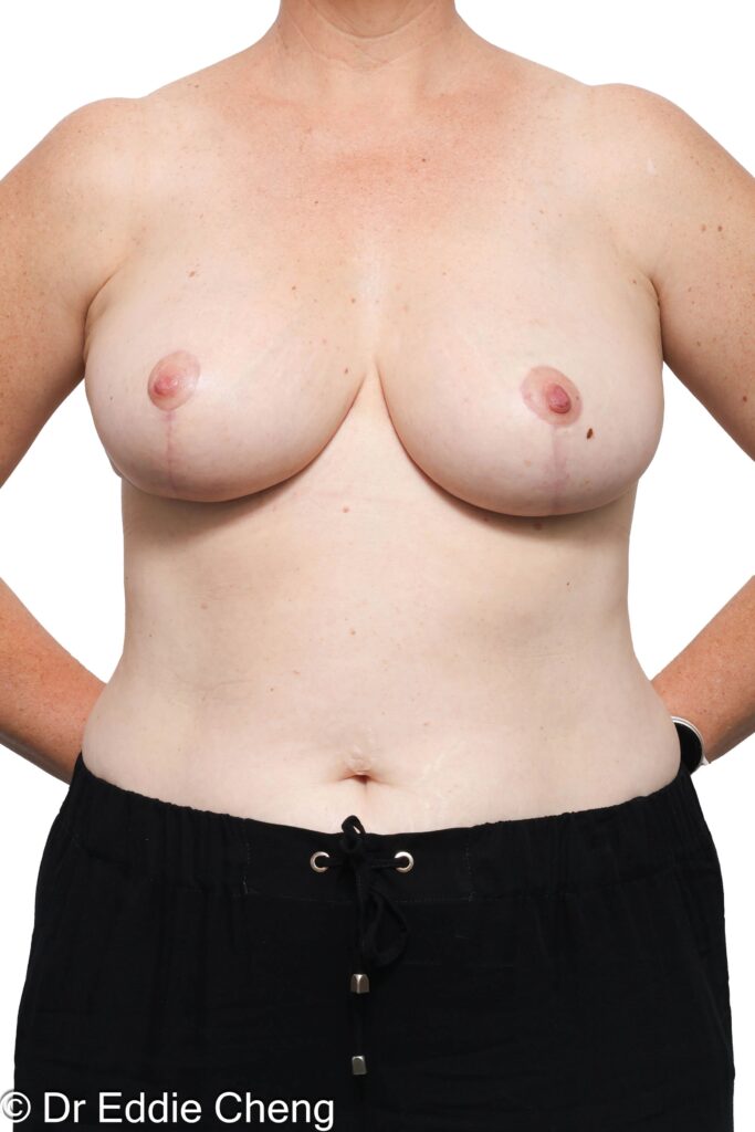 Before and after breast reduction surgery by Dr Eddie Cheng, Brisbane