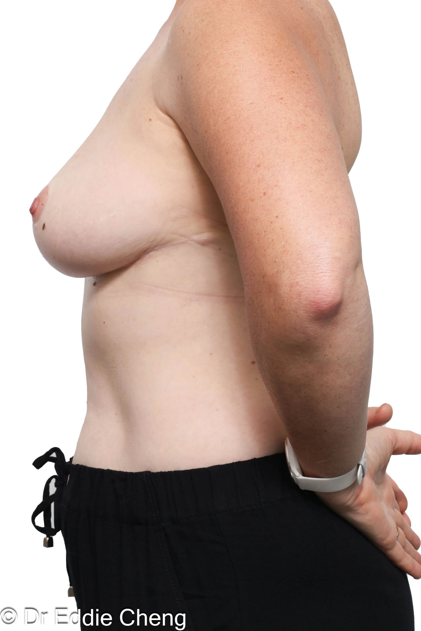 Before and after breast reduction surgery by Dr Eddie Cheng, Brisbane