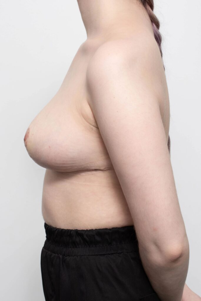 Before and after breast reduction surgery by Dr Eddie Cheng, Brisbane