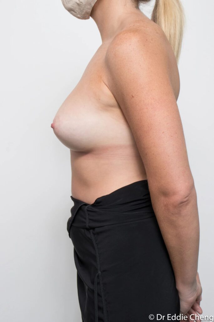 Before and after breast augmentation surgery by Dr Eddie Cheng, Brisbane