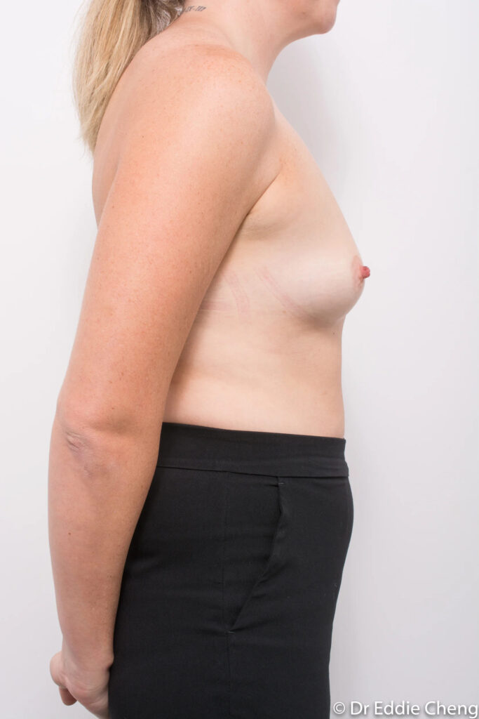 Before and after breast augmentation surgery by Dr Eddie Cheng, Brisbane