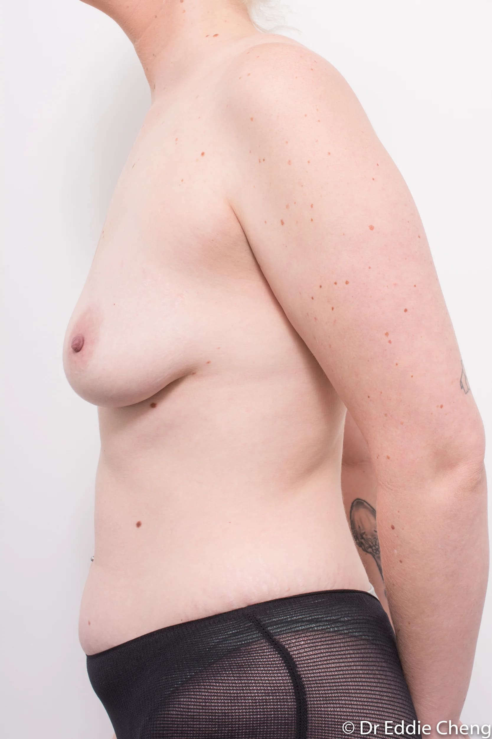 Before and after breast augmentation surgery by Dr Eddie Cheng, Brisbane