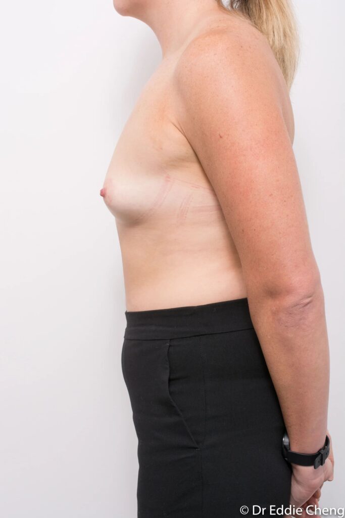 Before and after breast augmentation surgery by Dr Eddie Cheng, Brisbane