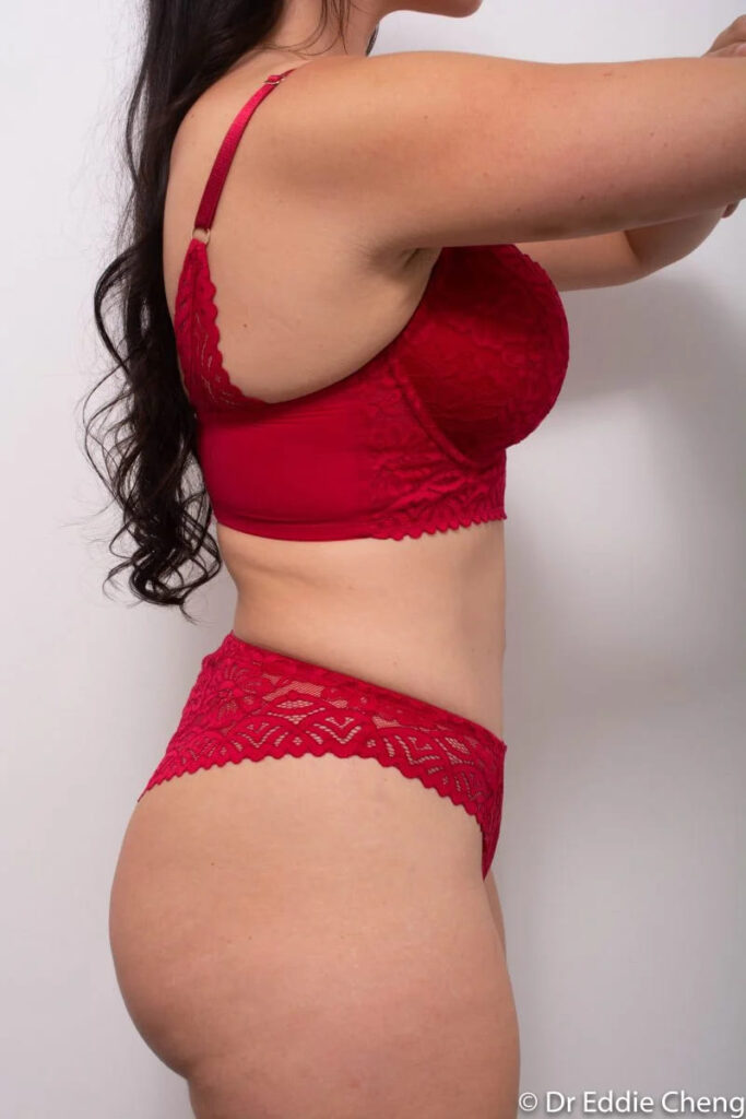Before and after Abdominoplasty by Dr Eddie Cheng, Brisbane