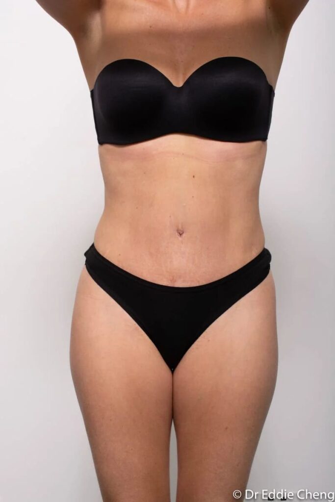 Before and after Abdominoplasty by Dr Eddie Cheng, Brisbane