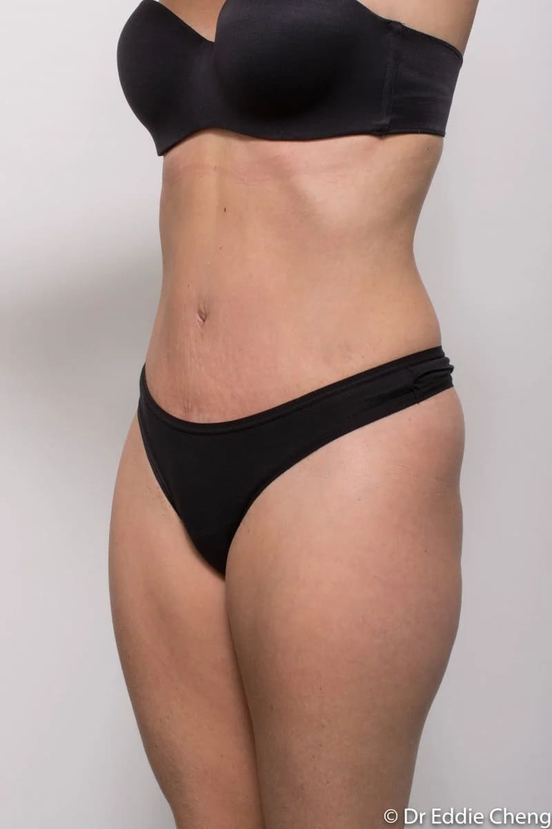 Before and after Abdominoplasty by Dr Eddie Cheng, Brisbane