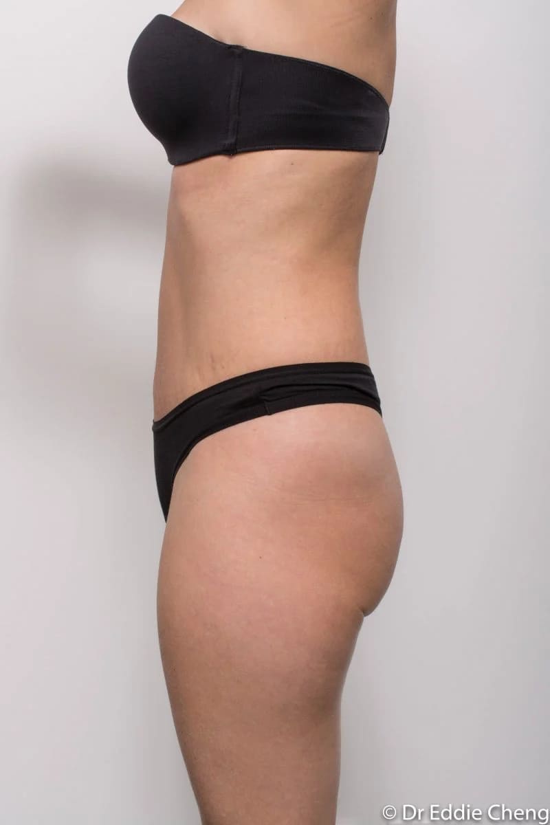 Before and after Abdominoplasty by Dr Eddie Cheng, Brisbane