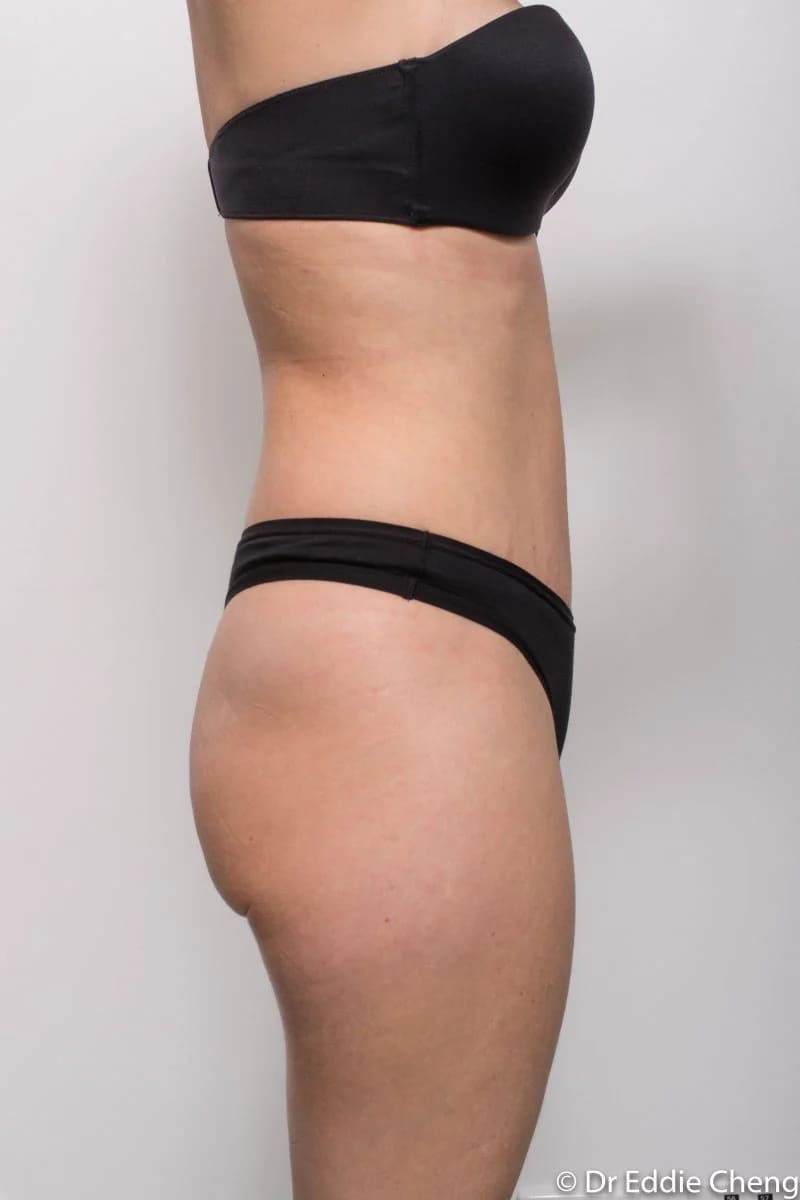 Before and after Abdominoplasty by Dr Eddie Cheng, Brisbane