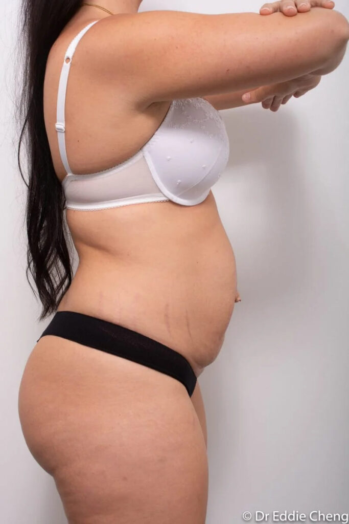 Before and after Abdominoplasty by Dr Eddie Cheng, Brisbane