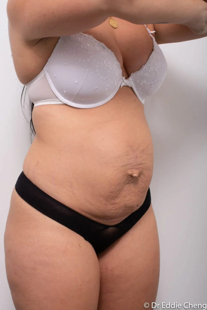 Before and after Abdominoplasty by Dr Eddie Cheng, Brisbane