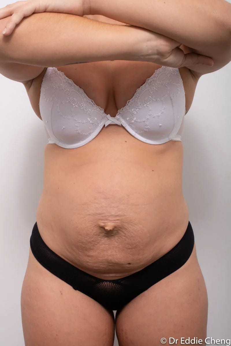 Before and after Abdominoplasty by Dr Eddie Cheng, Brisbane