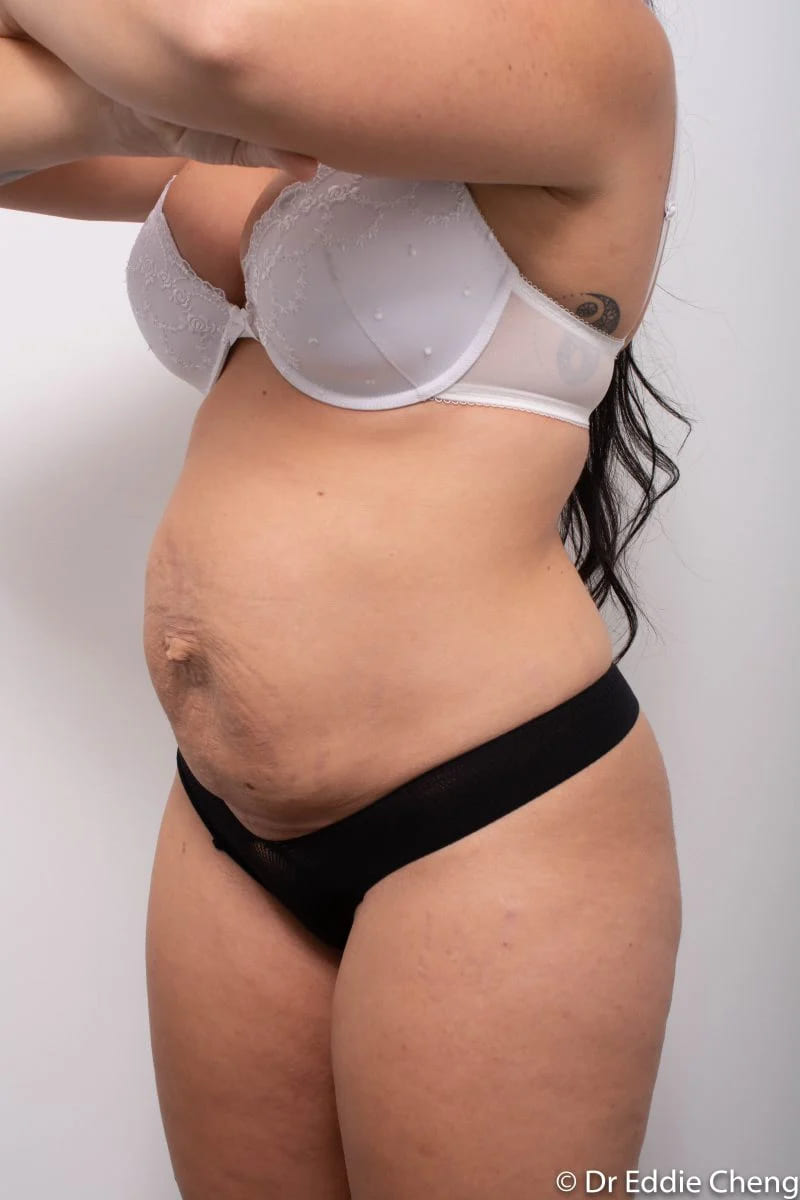 Before and after Abdominoplasty by Dr Eddie Cheng, Brisbane