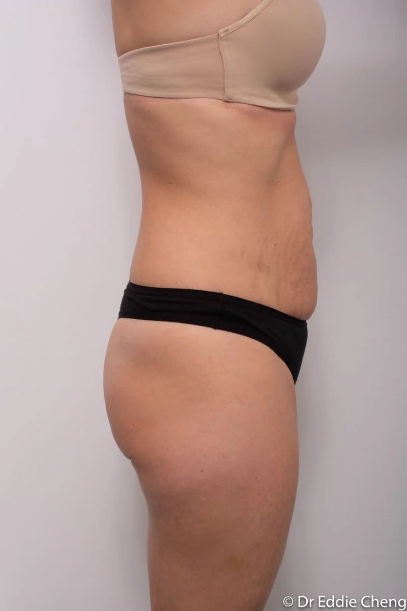 Before and after Abdominoplasty by Dr Eddie Cheng, Brisbane