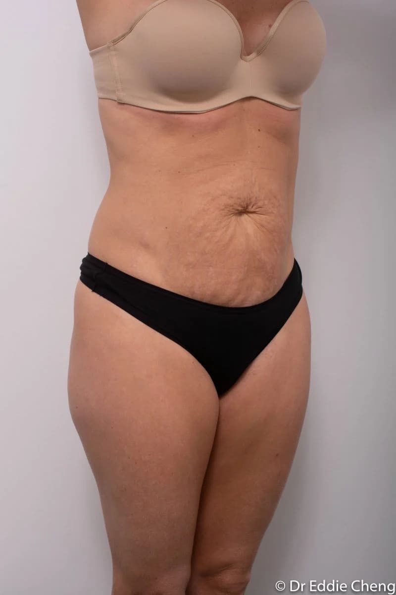 Before and after Abdominoplasty by Dr Eddie Cheng, Brisbane