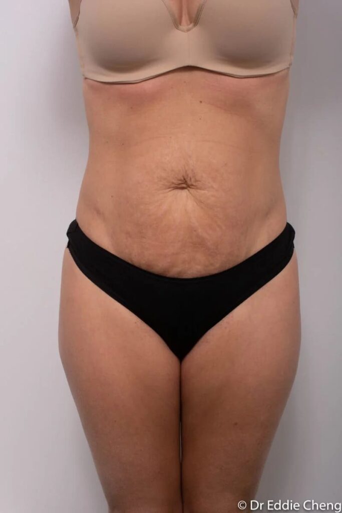 Before and after Abdominoplasty by Dr Eddie Cheng, Brisbane