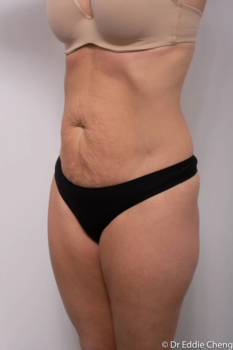 Before and after Abdominoplasty by Dr Eddie Cheng, Brisbane
