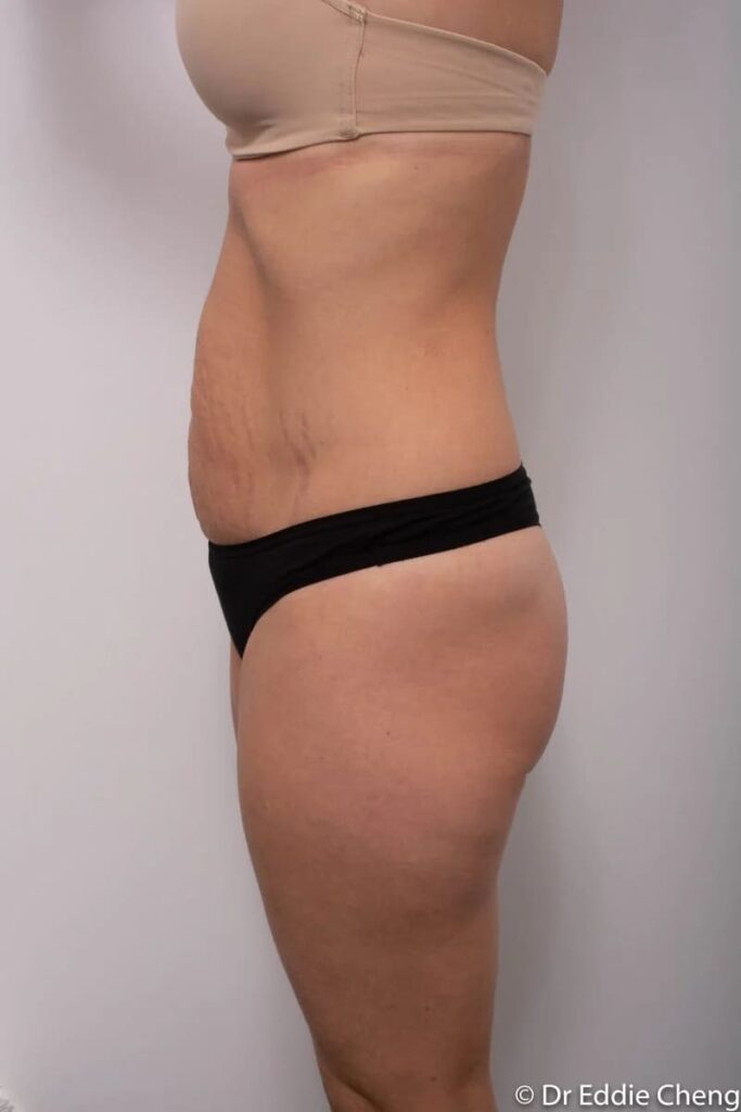 Before and after Abdominoplasty by Dr Eddie Cheng, Brisbane