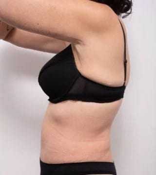 Before and after Abdominoplasty by Dr Eddie Cheng, Brisbane