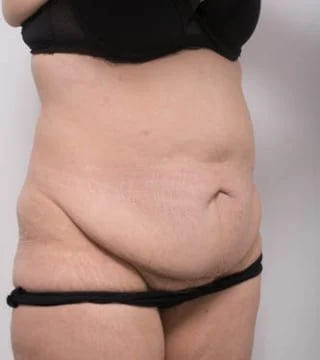 Before and after Abdominoplasty by Dr Eddie Cheng, Brisbane