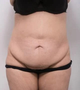 Before and after Abdominoplasty by Dr Eddie Cheng, Brisbane