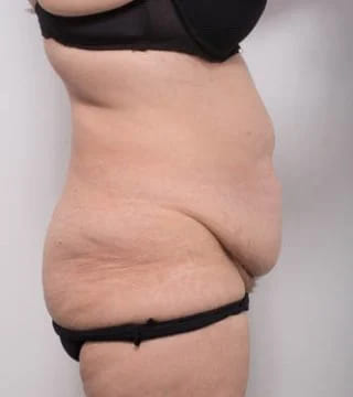 Before and after Abdominoplasty by Dr Eddie Cheng, Brisbane