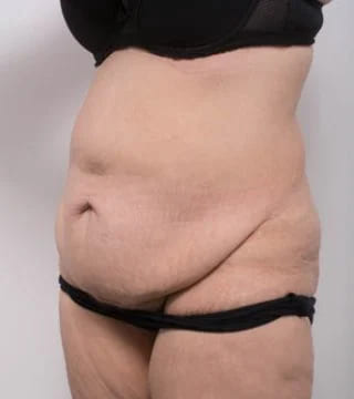 Before and after Abdominoplasty by Dr Eddie Cheng, Brisbane