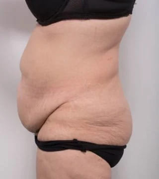Before and after Abdominoplasty by Dr Eddie Cheng, Brisbane