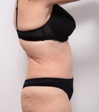 Before and after Abdominoplasty by Dr Eddie Cheng, Brisbane