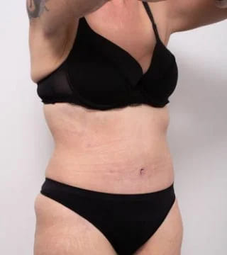 Before and after Surgery by Dr Eddie Cheng, Brisbane