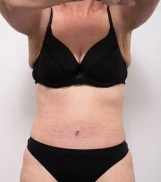Before and after Surgery by Dr Eddie Cheng, Brisbane