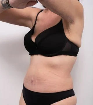 Before and after Surgery by Dr Eddie Cheng, Brisbane
