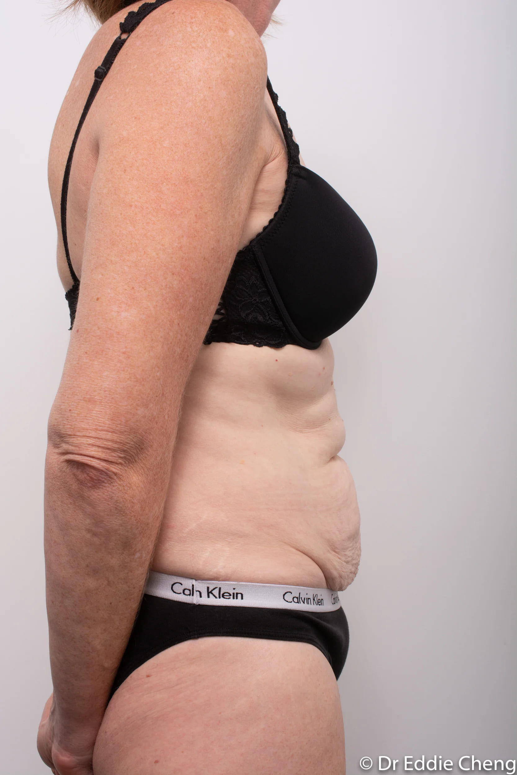 Before and after Abdominoplasty by Dr Eddie Cheng, Brisbane