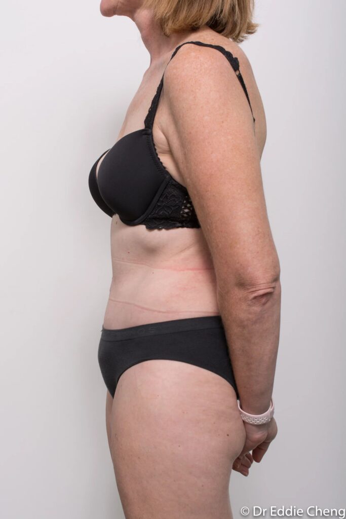 Before and after Abdominoplasty by Dr Eddie Cheng, Brisbane