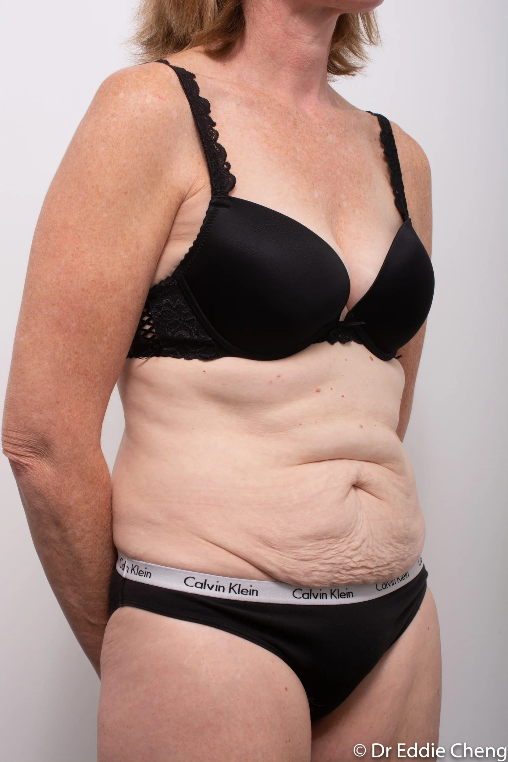 Before and after Abdominoplasty by Dr Eddie Cheng, Brisbane