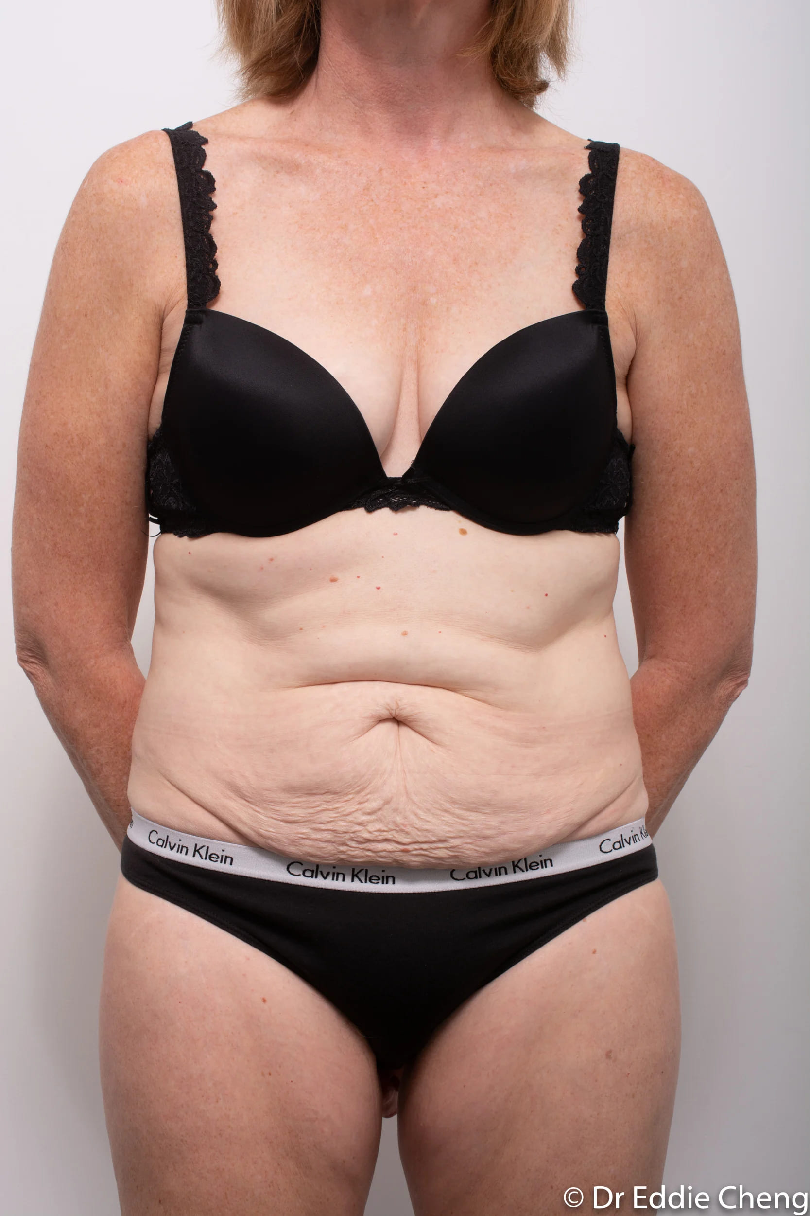 Before and after Abdominoplasty by Dr Eddie Cheng, Brisbane