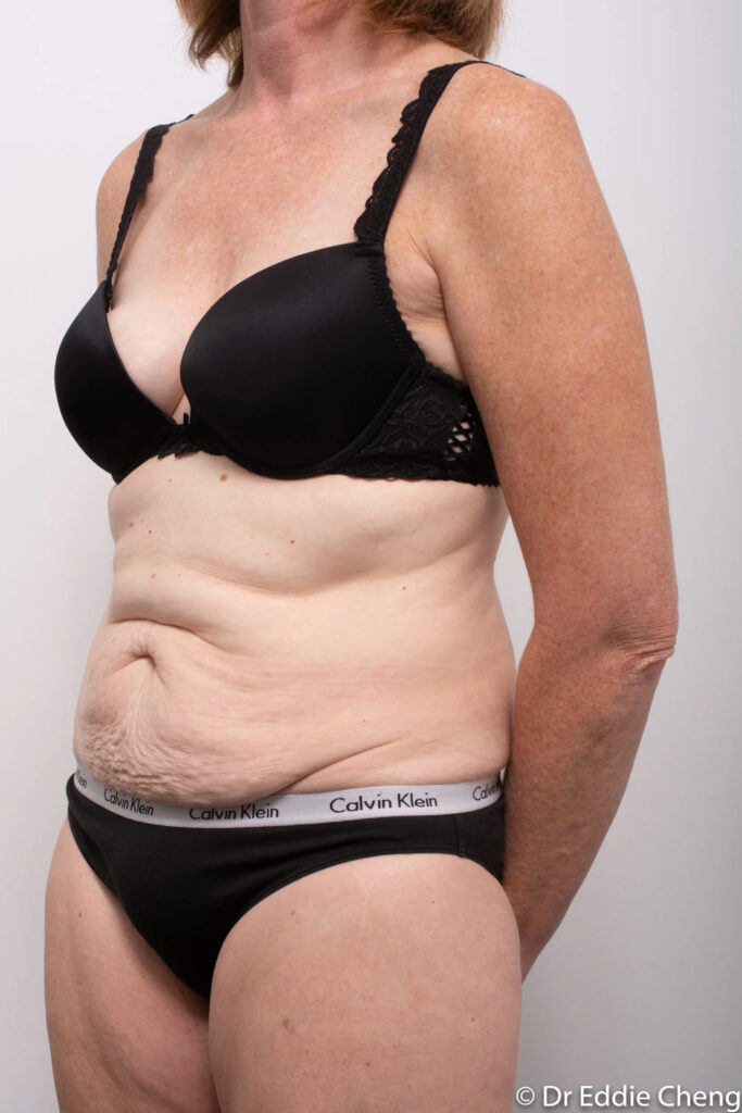 Before and after Abdominoplasty by Dr Eddie Cheng, Brisbane