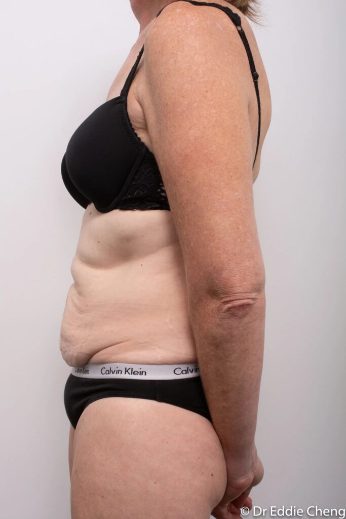 Before and after Abdominoplasty by Dr Eddie Cheng, Brisbane