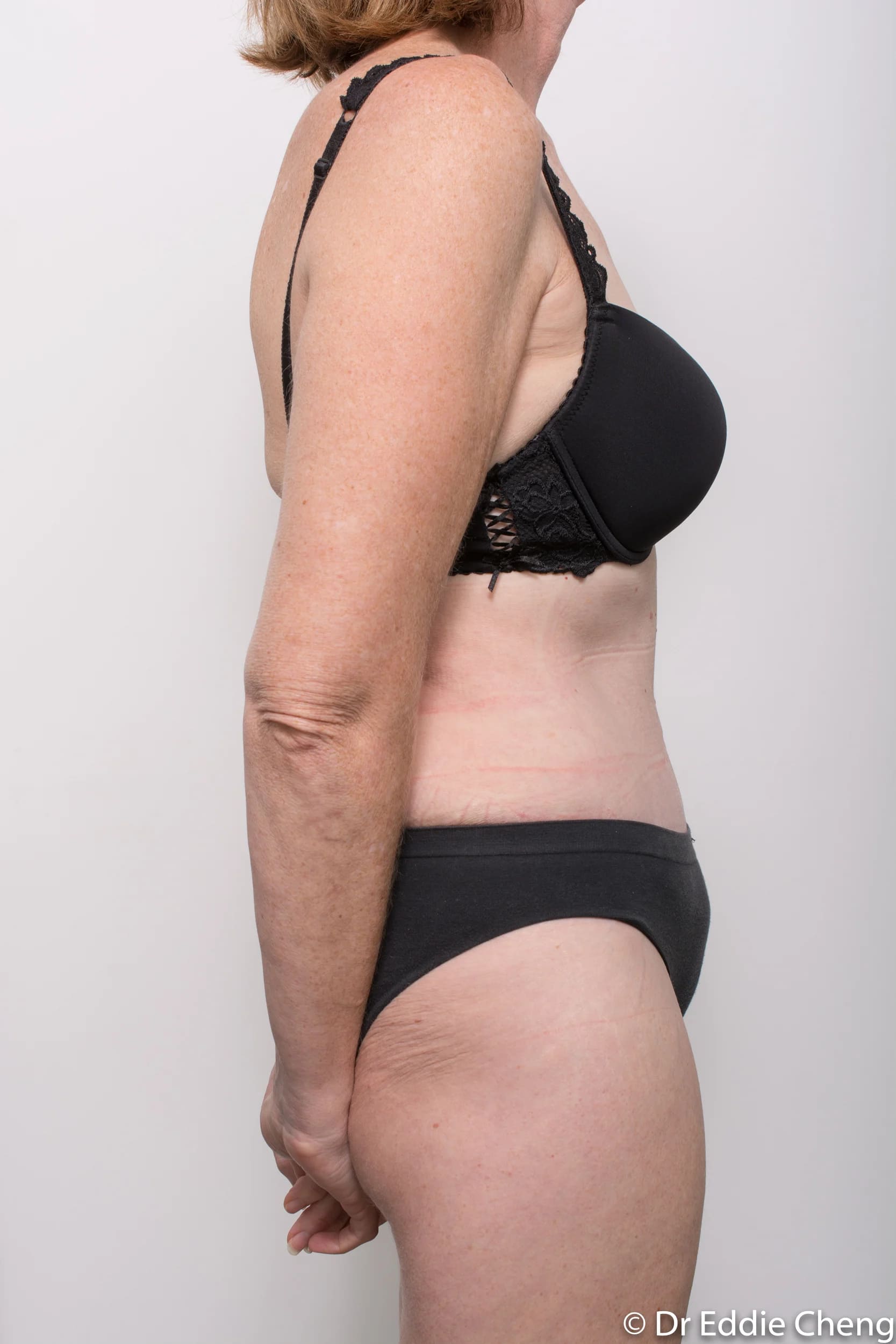 Before and after Abdominoplasty by Dr Eddie Cheng, Brisbane