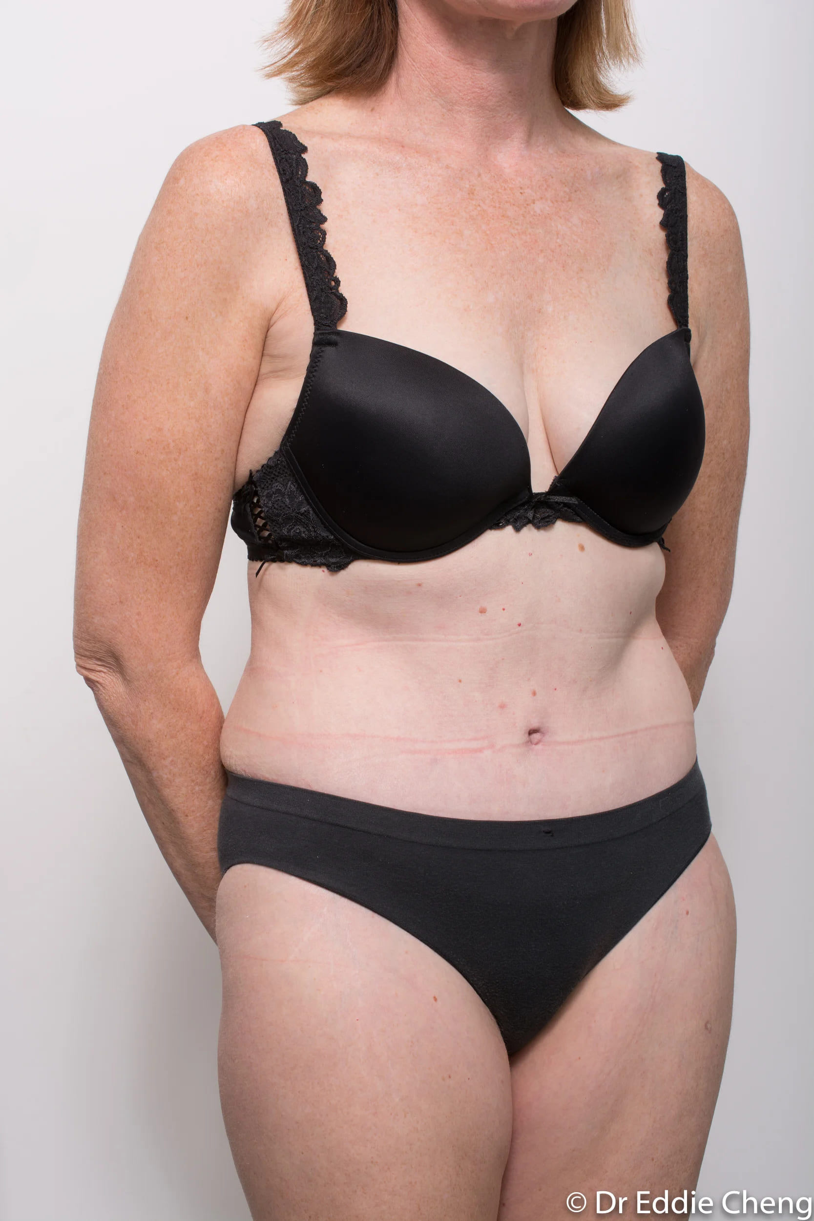 Before and after Abdominoplasty by Dr Eddie Cheng, Brisbane