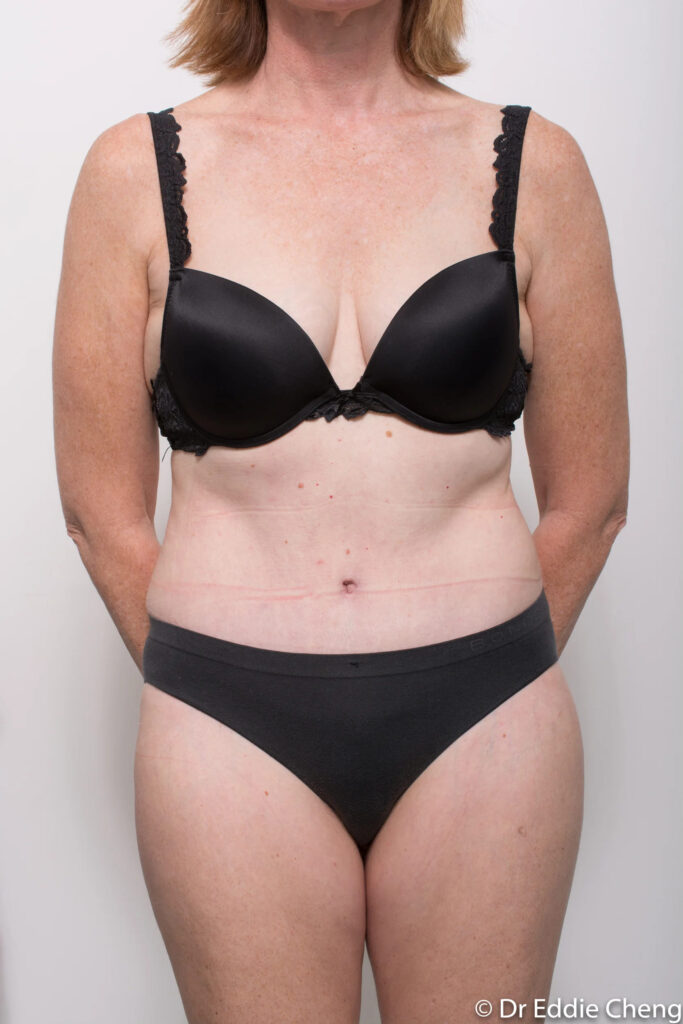 Before and after Abdominoplasty by Dr Eddie Cheng, Brisbane