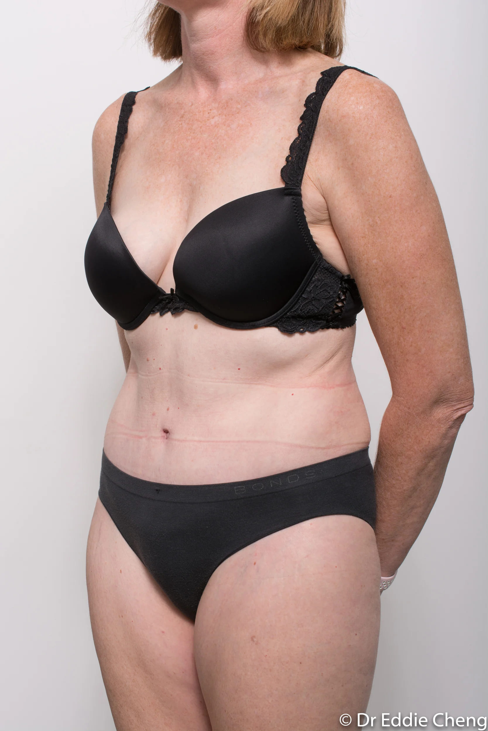 Before and after Abdominoplasty by Dr Eddie Cheng, Brisbane