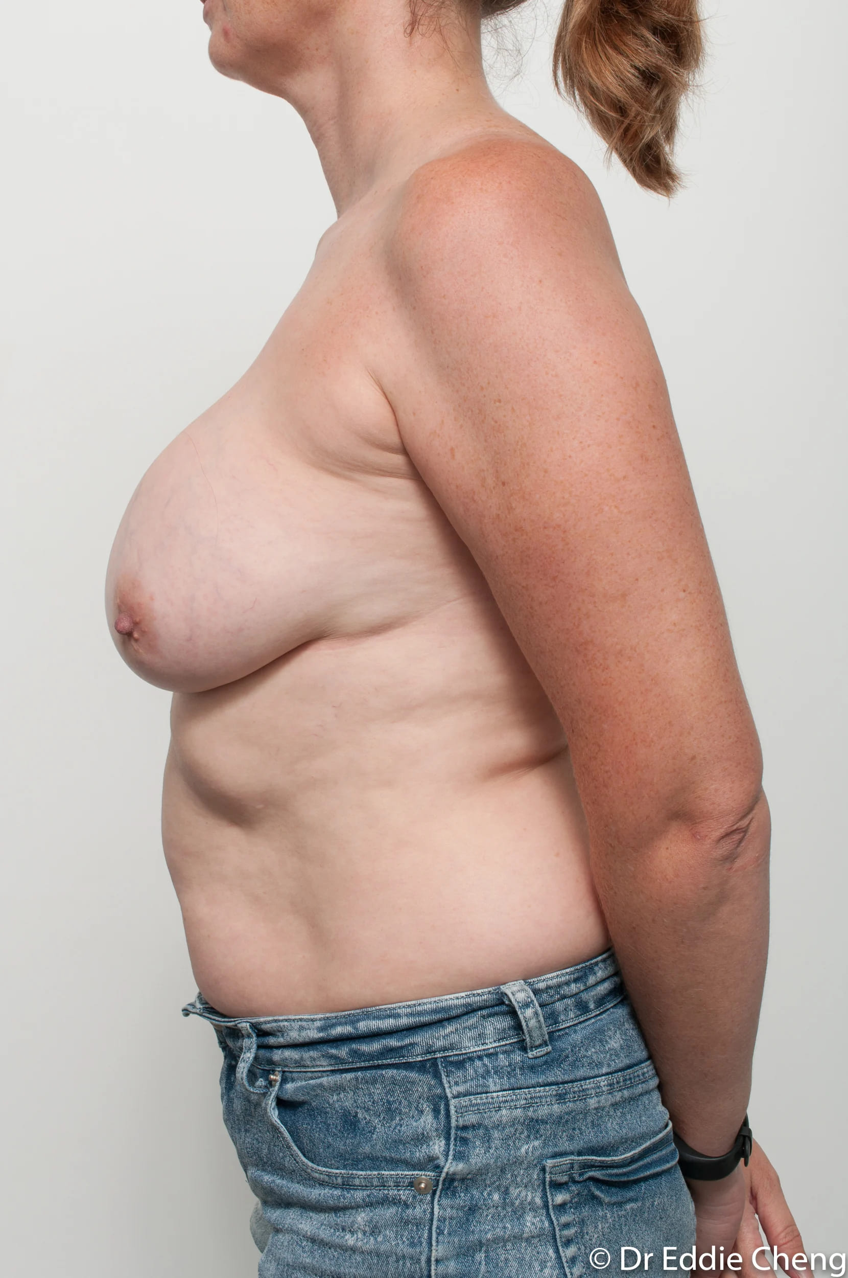 Before and after breast augmentation by Dr Eddie Cheng, Brisbane