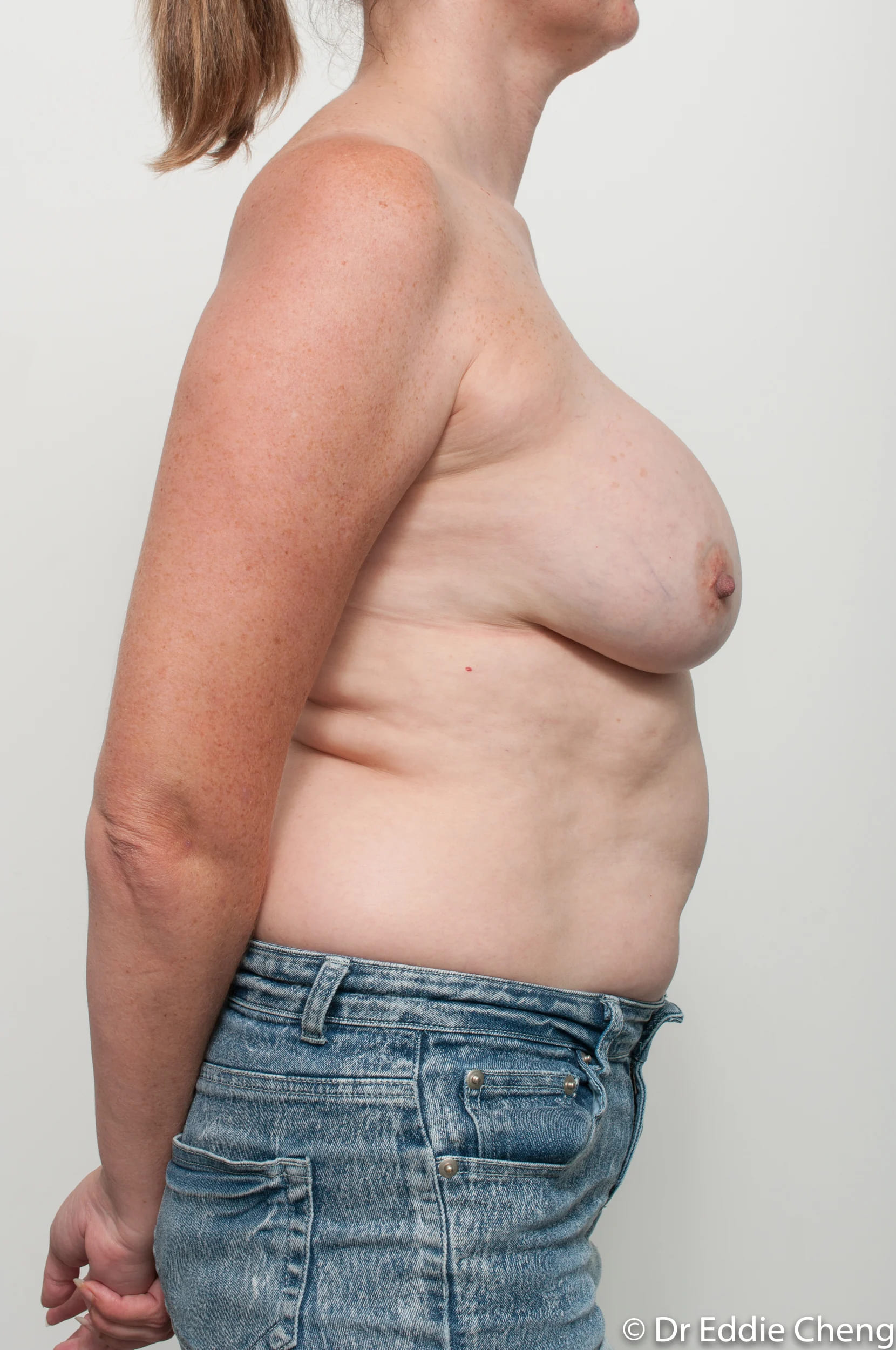 Before and after breast augmentation by Dr Eddie Cheng, Brisbane